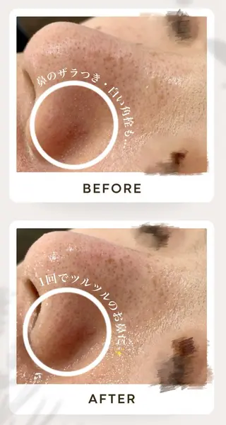 AY'S所属・倉敷/玉島/20代 からの大人毛穴洗浄のエステ・リラクイメージ