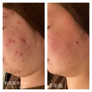 ミディアム カラー パーマ ヘアアレンジ メンズ キッズ ネイル マツエク・マツパ ニキビ跡専門サロン Ainaのエステ・リラクイメージ