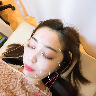 リフトアップ・たるみ ☆美容鍼小顔矯正のその他イメージ