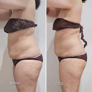 脂肪冷却 & 脱毛 AYUMIのその他イメージ