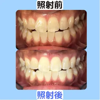 ホワイトニング｜韓国式3D毛穴洗浄 lonhana ﾛﾝﾊﾅ所属・韓国式3D毛穴洗浄 lonhanaのその他イメージ