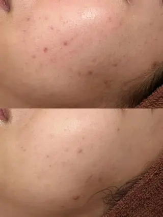 🔥3か月で肌革命 🔥ニキビ専門店のエステ・リラクイメージ