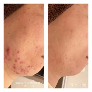 ショート カラー パーマ ヘアアレンジ メンズ キッズ ネイル マツエク・マツパ アイブロウ ニキビ跡専門サロン Ａｉｎａのエステ・リラクイメージ