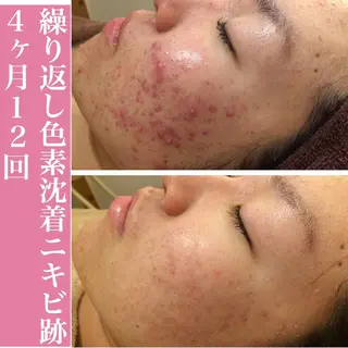 セミロング カラー パーマ ヘアアレンジ メンズ キッズ ネイル 🔥3か月で肌革命 🔥ニキビ専門店のエステ・リラクイメージ