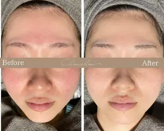 beauty & health salon Chou chou所属・ニキビ・毛穴🌿肌を 育てるララピール✨のエステ・リラクイメージ