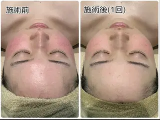 ハーブピーリング ララピール術後ケアのその他イメージ