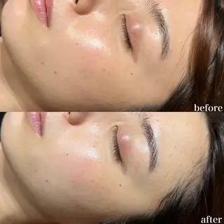 mieux所属・ハーブピーリング ¥6600のエステ・リラクイメージ