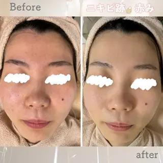 ニキビ&跡改善サロン オーナー光木のエステ・リラクイメージ