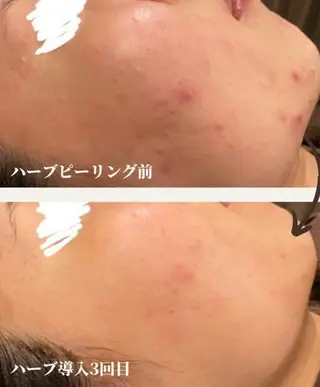 本気の肌質改善スキン デトックス🌿のエステ・リラクイメージ