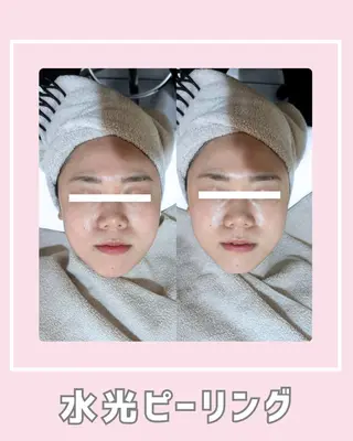 |ピーリング・毛穴| soina神楽坂のエステ・リラクイメージ