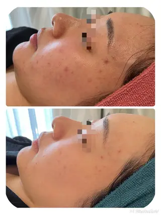 【リベルハーブピーリング認定店】敏感肌・美白脱毛専門店Dione立川店所属・Dione 立川店のエステ・リラクイメージ