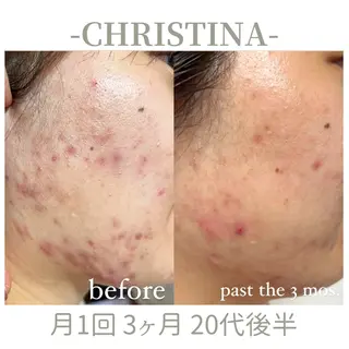 肌質改善|天王寺 For...はるかのエステ・リラクイメージ