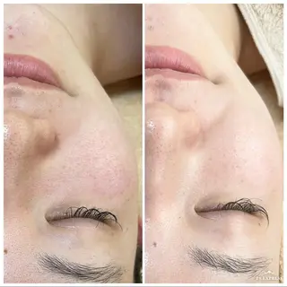 マツエク・マツパ ニキビ・毛穴改善 🌿ハーブピーリングのエステ・リラクイメージ