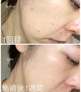 Belsia千歳烏山 ピーリング＆眉毛のエステ・リラクイメージ