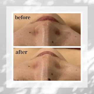 フローフシ∞💙 毛穴洗浄で毛穴レスのエステ・リラクイメージ
