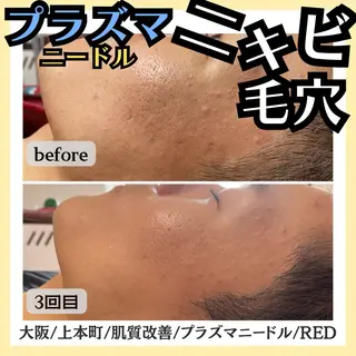 毛穴レス ハーブ& ワックス脱毛×光脱毛のエステ・リラクイメージ