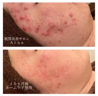 セミロング カラー パーマ ヘアアレンジ メンズ キッズ ネイル マツエク・マツパ ニキビ跡専門サロン Ａｉｎａのエステ・リラクイメージ