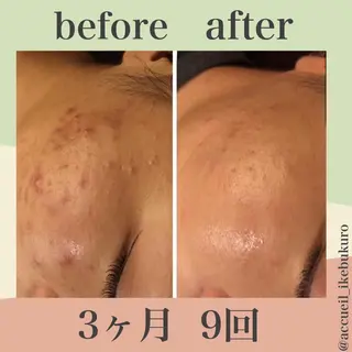 ミディアム カラー パーマ ヘアアレンジ ネイル マツエク・マツパ ニキビ・肌質改善専門 ♡人生が変わるサロンのエステ・リラクイメージ