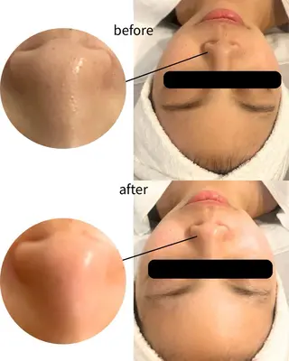 心斎橋 ピーリング/ 毛穴 / POLAのエステ・リラクイメージ