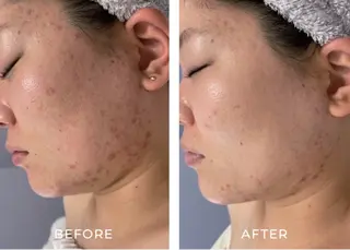 毛穴ケア くすみ肌 ハーブピーリングのエステ・リラクイメージ