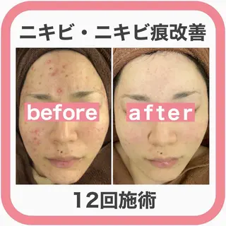 ニキビ特化型エステ 🍓最短で肌質改善のエステ・リラクイメージ