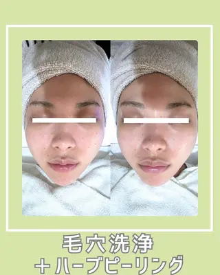 |ピーリング・毛穴| soina神楽坂のエステ・リラクイメージ