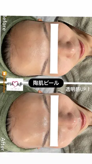 Meupニキビ専門店 背中/ハーブ/肌管理のその他イメージ