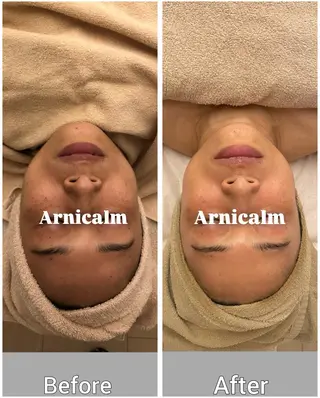 ハーブピーリング 肌再生ピーリング/のエステ・リラクイメージ