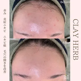 【剥離ありハーブピーリング専門エステ】cerisier BEAUTÉ 原宿所属・cerisier BEAUTÉのエステ・リラクイメージ