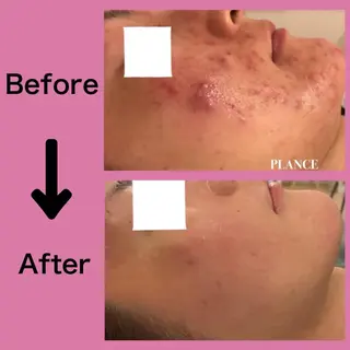 フェイシャル専門 肌質改善/プランスのエステ・リラクイメージ