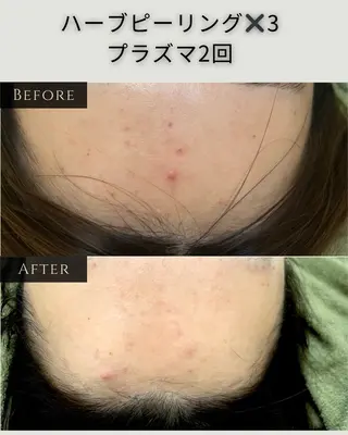 シミ毛穴|眉Wax THE  flowのエステ・リラクイメージ