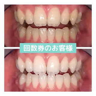 ホワイトニング｜韓国式3D毛穴洗浄 lonhana ﾛﾝﾊﾅ所属・韓国式3D毛穴洗浄 lonhanaのその他イメージ