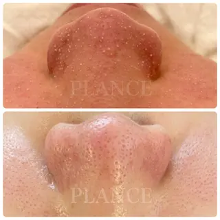 フェイシャル専門 肌質改善/プランスのエステ・リラクイメージ