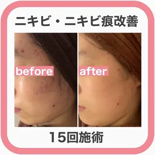 学生ニキビ改善🍀 優しい肌質改善のエステ・リラクイメージ
