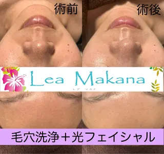 Lea Makana-レアマカナ所属・毛穴洗浄🍀脱毛🍀 光フェイシャル🍀のエステ・リラクイメージ