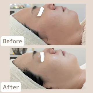 レチノール/ニキビ/ 毛穴ケア 浅川のエステ・リラクイメージ