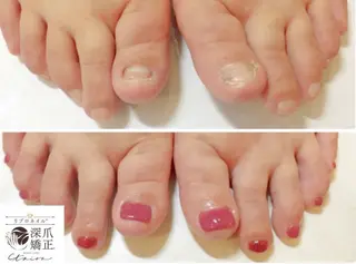 メンズ ネイル 深爪矯正専門店　ネイルサロン　トイロ所属・ネイルサロン トイロのネイルデザイン