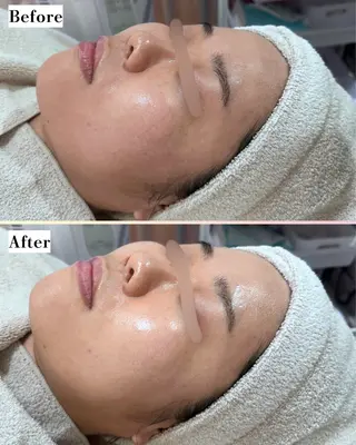 |ピーリング・毛穴| soina神楽坂のエステ・リラクイメージ