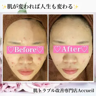 ニキビ・肌質改善専門 ♡人生が変わるサロンのエステ・リラクイメージ