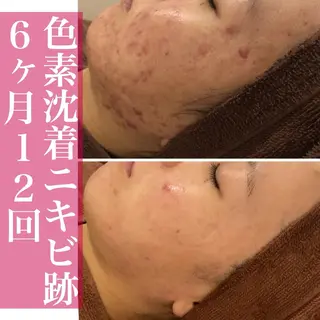 学生ニキビ改善🍀 優しい肌質改善のエステ・リラクイメージ
