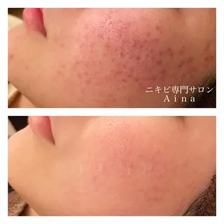 セミロング カラー パーマ ヘアアレンジ メンズ キッズ ネイル マツエク・マツパ ニキビ跡専門サロン Ainaのエステ・リラクイメージ