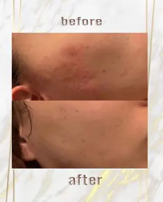 ハーブピーリング特選 認定rebirthのエステ・リラクイメージ