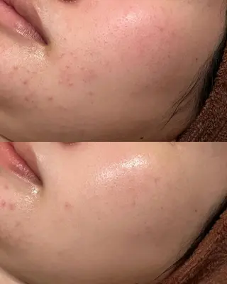 🔥3か月で肌革命 🔥ニキビ専門店のエステ・リラクイメージ