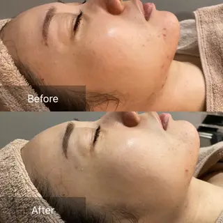 和漢よもぎ蒸しとフェイシャルのお店　maison de beaute所属・よもぎ蒸し/ 大人ニキビ　mamiのエステ・リラクイメージ