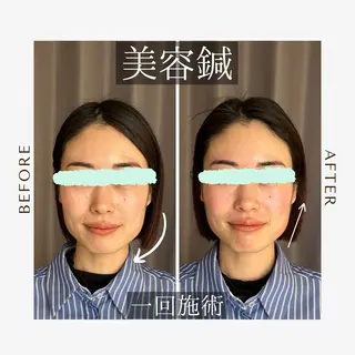 鍼灸•マッサージサロンCalfa所属・《美肌･小顔》美容鍼 ＆マッサージ＊MEIのエステ・リラクイメージ
