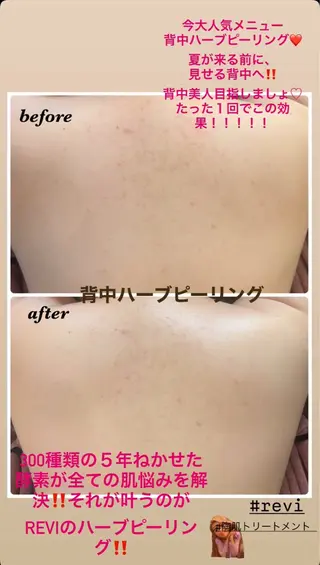 ハーブピーリング/韓国肌管理/フェイシャル/毛穴洗浄/眉毛/顔脱毛【糸脱毛専門】rev所属・ハーブピーリング🌹 毛穴洗浄❤️眉waxのエステ・リラクイメージ