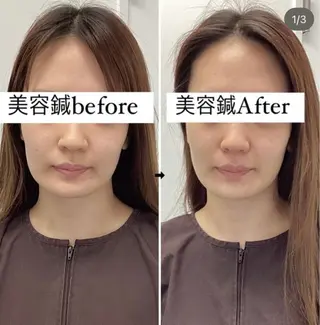 hari salon de off 美容鍼灸×小顔整体【ハリサロンドオフ】所属・美容鍼灸×小顔整体♡ ハリサロンドオフ堺東のエステ・リラクイメージ