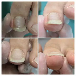 巻き爪補正店 大阪なんば店のネイルデザイン