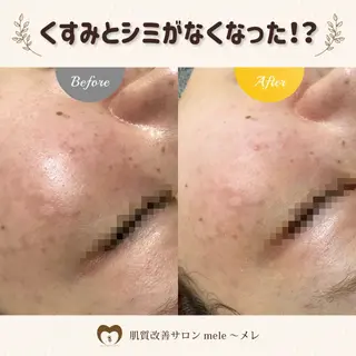 ニキビケア/毛穴/ 赤み/自信の肌✨森園のエステ・リラクイメージ