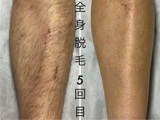 メンズ 肌管理脱毛ピーリング CDFAkasakaのエステ・リラクイメージ